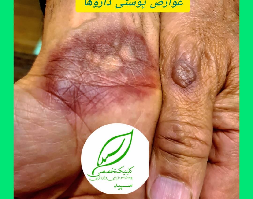 دارویی می‌تواند عارضه