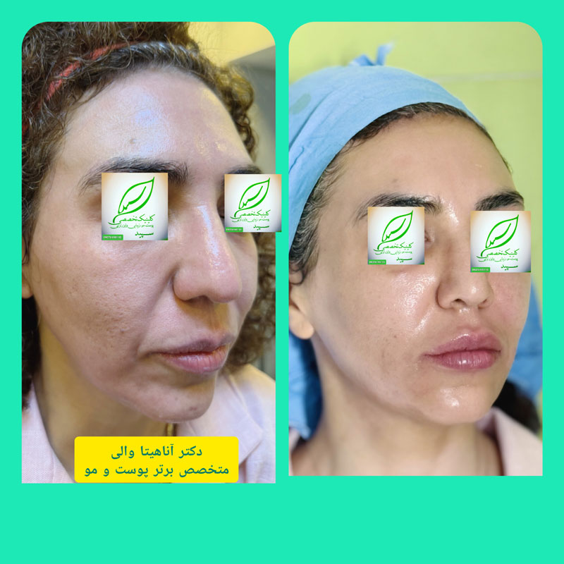 تزریق فیلر
